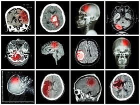 脑病收集（Ct扫描和脑Mri：显示脑梗死，脑内出血，脑肿瘤，基底神经结节出血（颅内切除术后状态） （保健概念）)