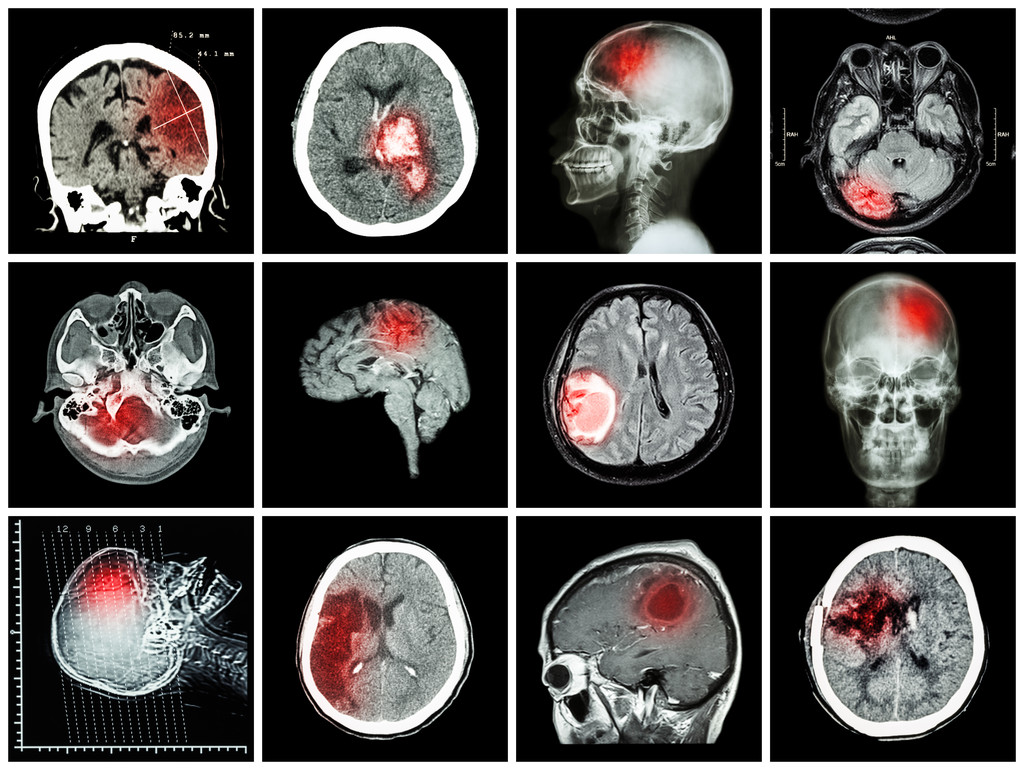 脑病收集（Ct扫描和脑Mri：显示脑梗死，脑内出血，脑肿瘤，基底神经结节出血（颅内切除术后状态） （保健概念）)