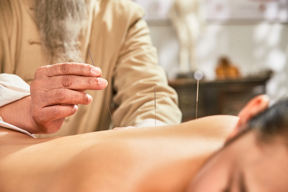 中医给年轻女子针灸治疗图片 中医给年轻女子针灸治疗图片