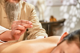 中医给年轻女子针灸治疗