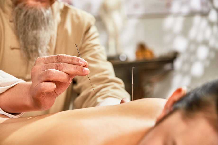 中医给年轻女子针灸治疗 中医给年轻女子针灸治疗