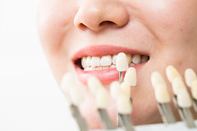 青年女人牙齿美容图片