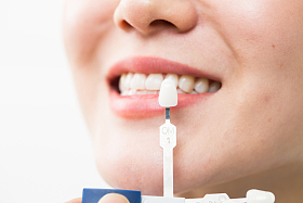 青年女人牙齿美容